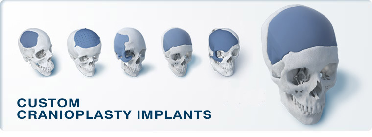 Custom Cranioplasty Implants