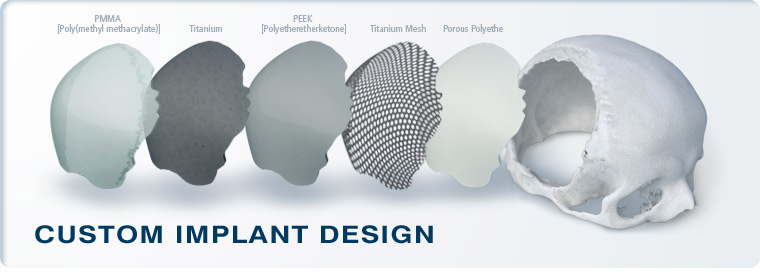 Custom Implant Design